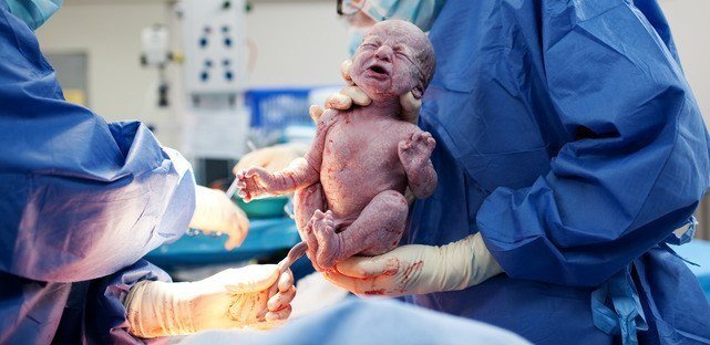c-section with twins