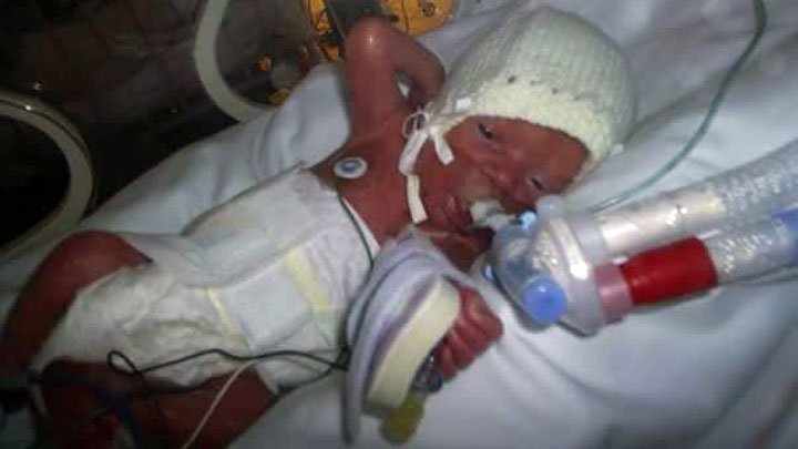 twin born at 27 weeks