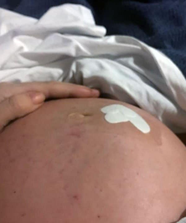 belly after ttts surgery