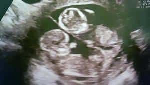 twin ultrasound 13 weeks