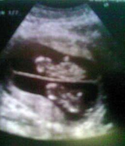 twin ultrasound 13 weeks
