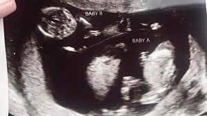 twin ultrasound 15 weeks